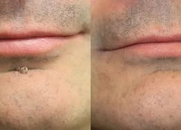 ✨Curalona®2-in-1 Microneedle & Hydrocolloid Patch🍀| Removes Raised Moles, Acne, Flat Warts & Skin Tags | Helps Improve Wrinkles, Scars & Blemishes | Invisible Patches for Face & Body.