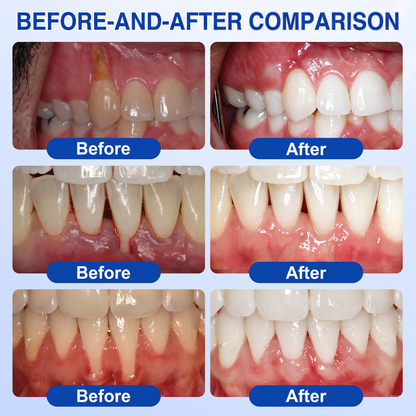 🇬🇧Purelora® 🦷 GumRevive periodontal repair gel 💖