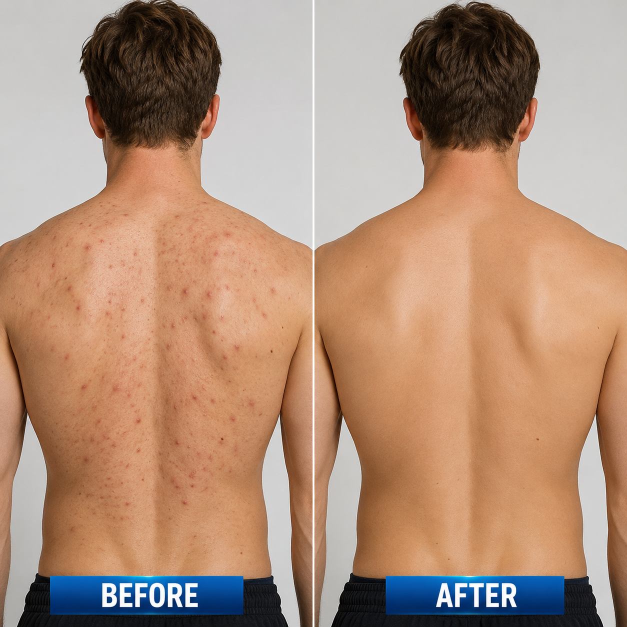🔥 【Official Store】PURELORA® 4-in-1 Body Spray — Acne Clear · Fade Marks · Smooth Bumps · Exfoliating Mist | Salicylic Acid + Menthol + Caffeine + Tea Tree | Made in UK