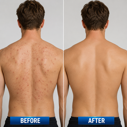 🔥 【Official Store】PURELORA® 4-in-1 Body Spray — Acne Clear · Fade Marks · Smooth Bumps · Exfoliating Mist | Salicylic Acid + Menthol + Caffeine + Tea Tree | Made in UK
