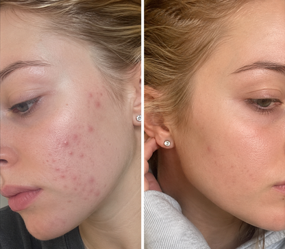 🔥 【Official Store】PURELORA® 4-in-1 Body Spray — Acne Clear · Fade Marks · Smooth Bumps · Exfoliating Mist | Salicylic Acid + Menthol + Caffeine + Tea Tree | Made in UK