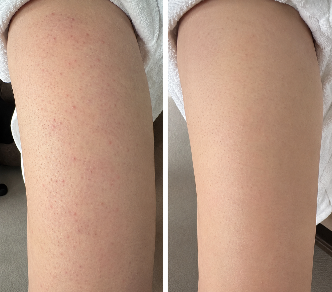 🔥 【Official Store】PURELORA® 4-in-1 Body Spray — Acne Clear · Fade Marks · Smooth Bumps · Exfoliating Mist | Salicylic Acid + Menthol + Caffeine + Tea Tree | Made in UK